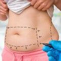 Rekonwalescencja po liposukcji - masaż i ubrania uciskowe na opuchliznę oraz obrzęki